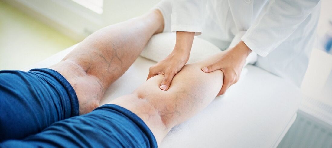 varicose veins on the legs and its treatment