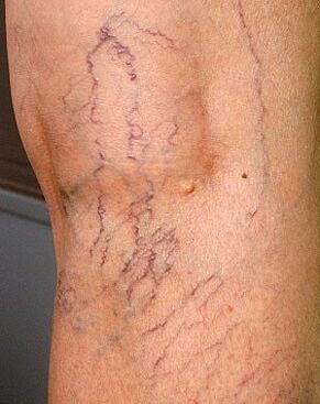 manifestations of varicose veins on the legs