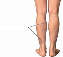 varicose veins in the legs