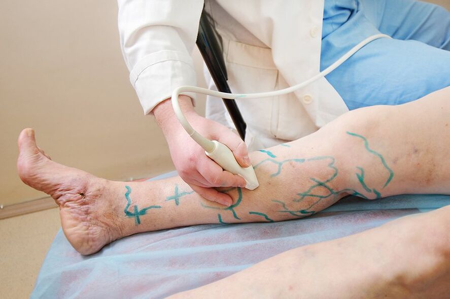 Preparation for miniflebectomy - marking on the lower leg perforators, performing ultrasonography